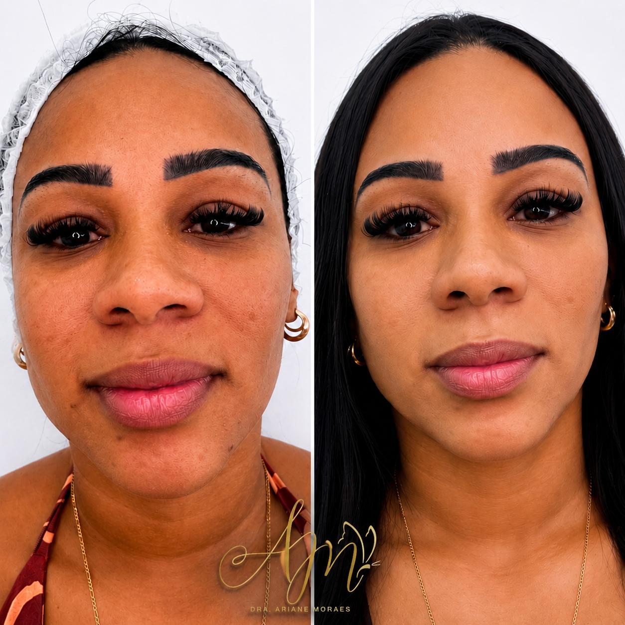 Antes e depois