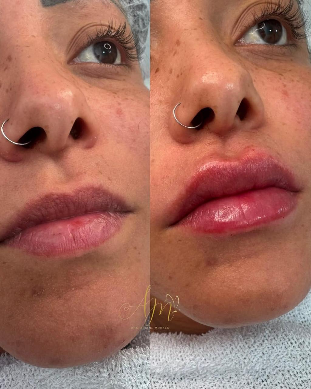 Antes e depois